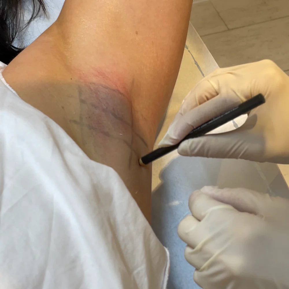 Antitranspirant Behandlung Einzeichnung