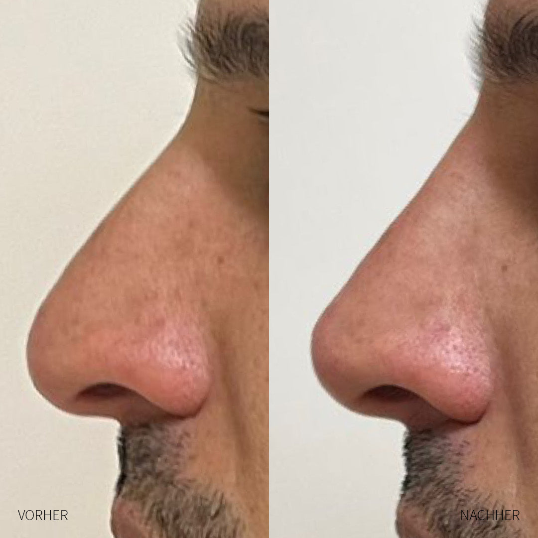 Vorher und Nachher Nasen Hyaluron-Unterspritzung Mann
