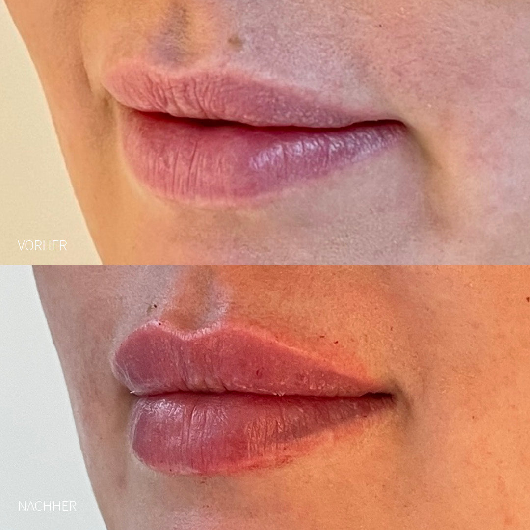 Lippen Hyaluron-Unterspritzung Frau vorher und nachher
