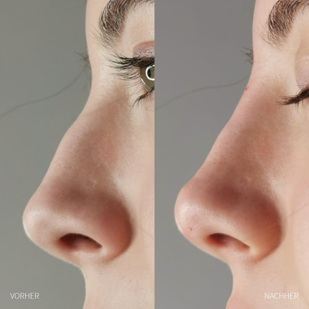 Nase Hyaluron-Unterspritzung Frau vorher und nachher