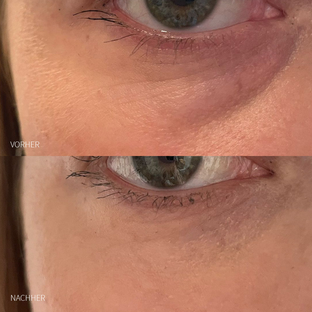 Augenringe Hyaluron-Unterspritzung Frau vorher und nachher