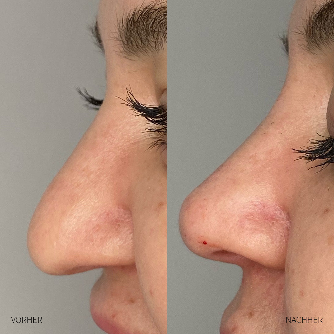 Nase Hyaluron-Unterspritzung Frau vorher und nachher